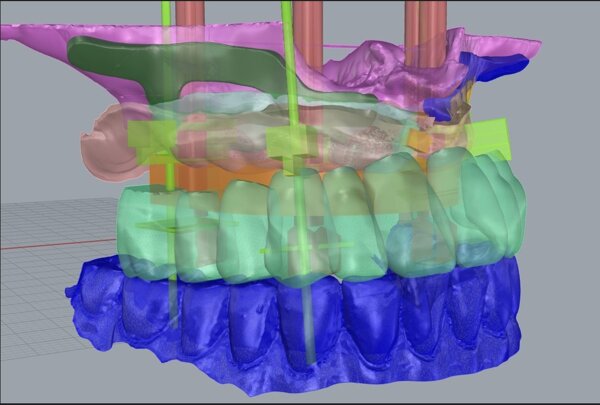 Impianti dentali Iuxta-Periostei: una soluzione per chi ha subito una perdita ossea